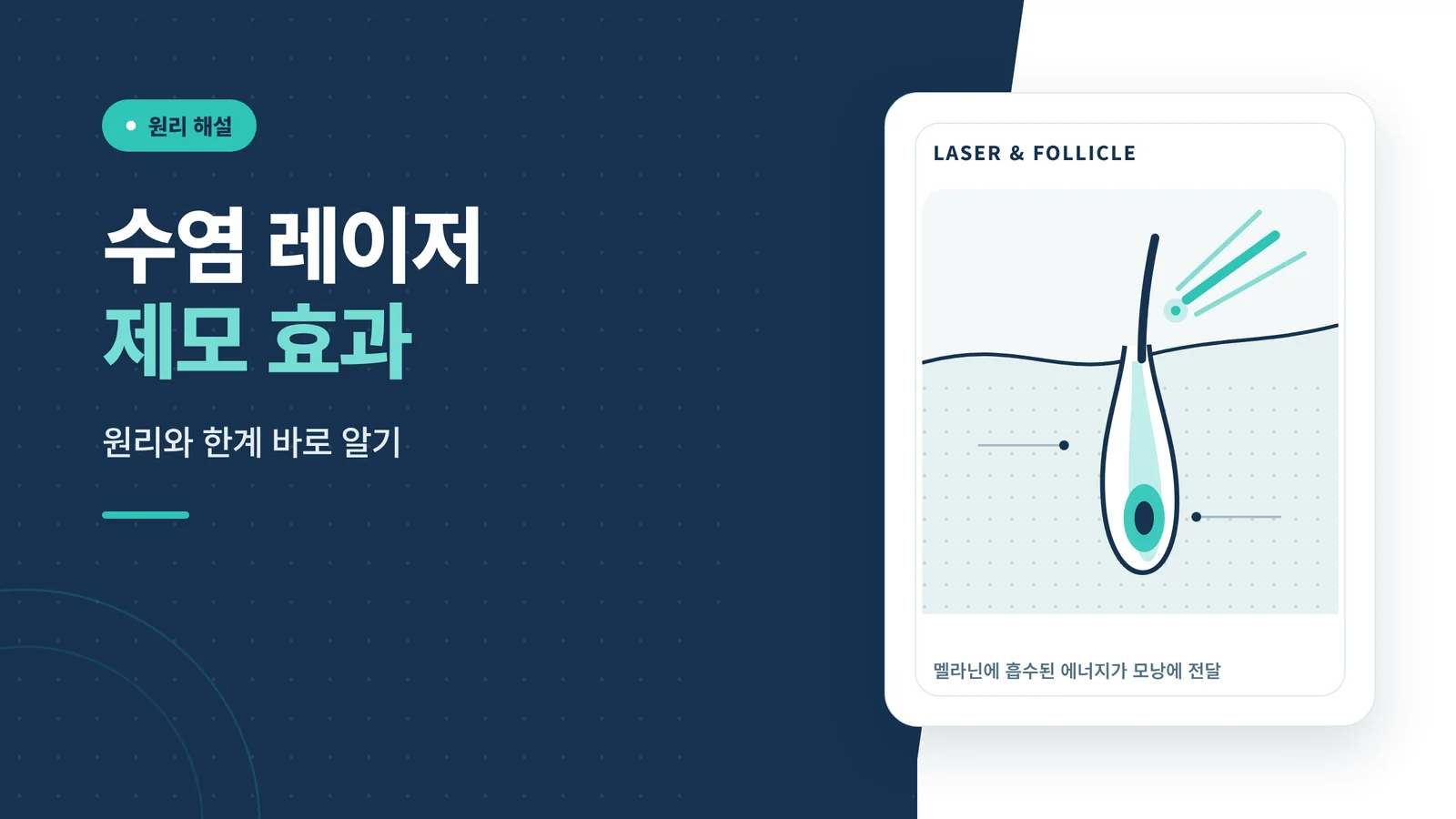 수염 레이저 제모 효과